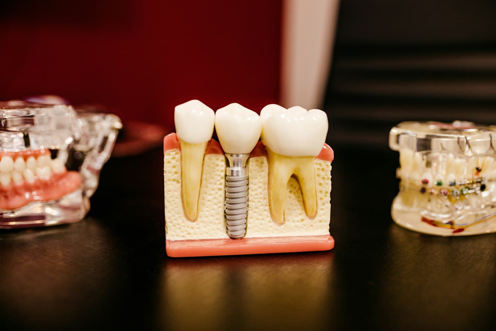 Cross-section model of a dental implant post, abutment and crown between natural teeth