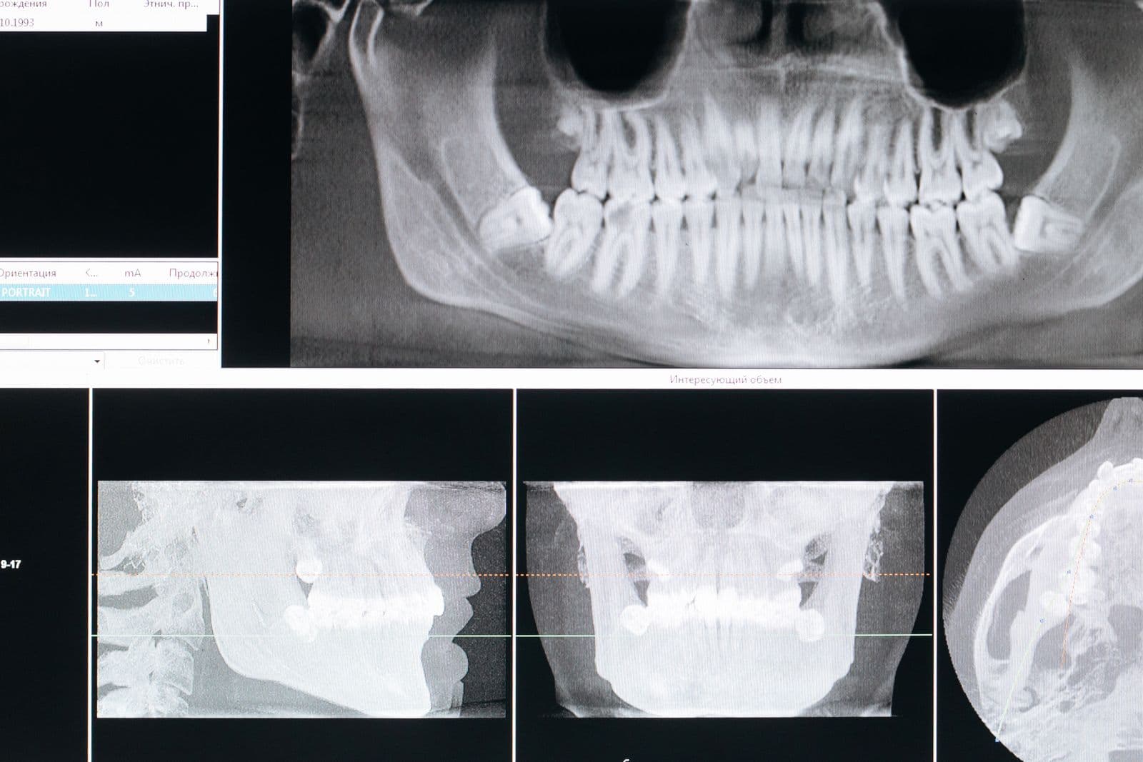 Full-mouth dental X-ray displayed on a monitor during diagnosis