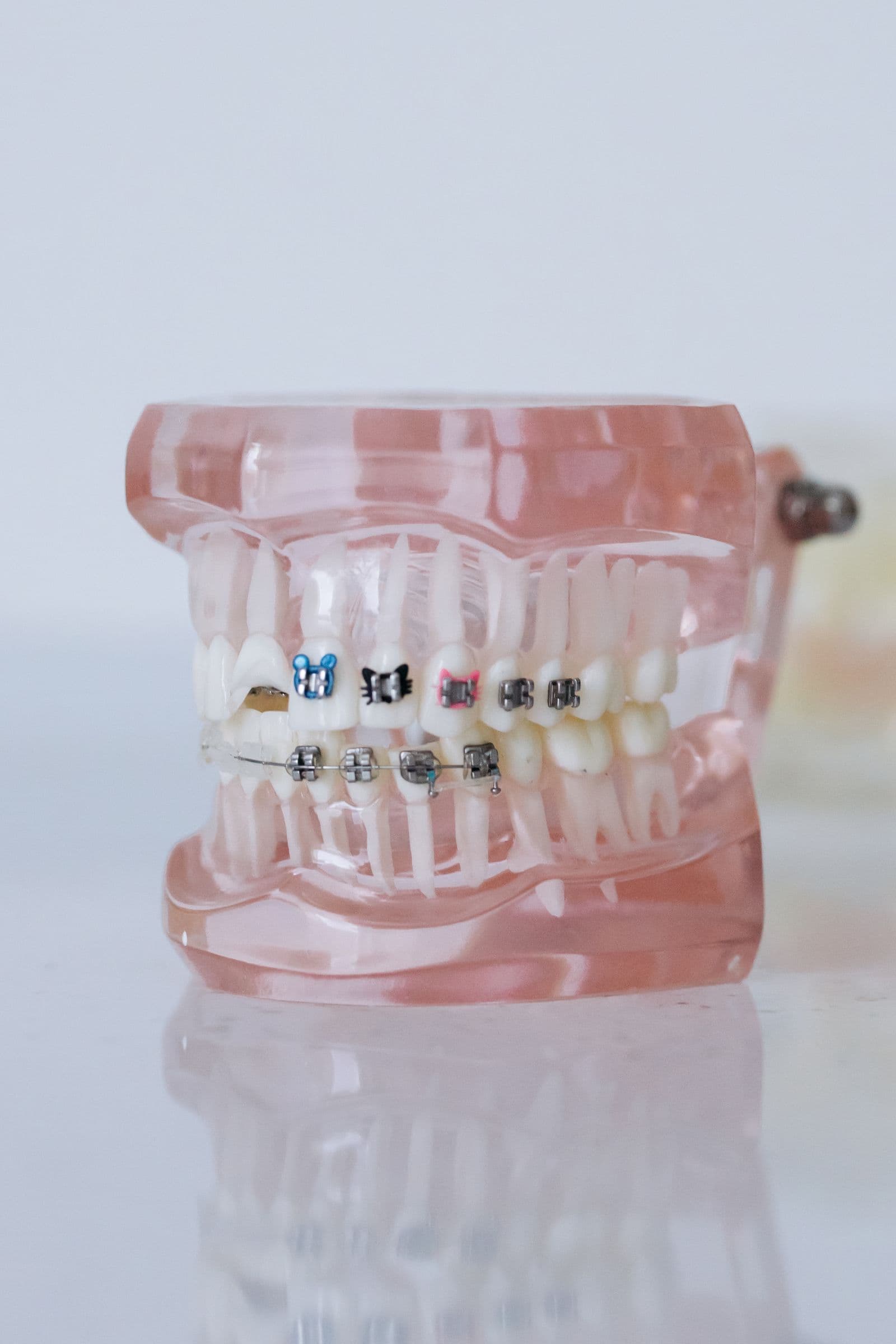 Close-up of a dental model showing fixed braces with coloured and metal brackets