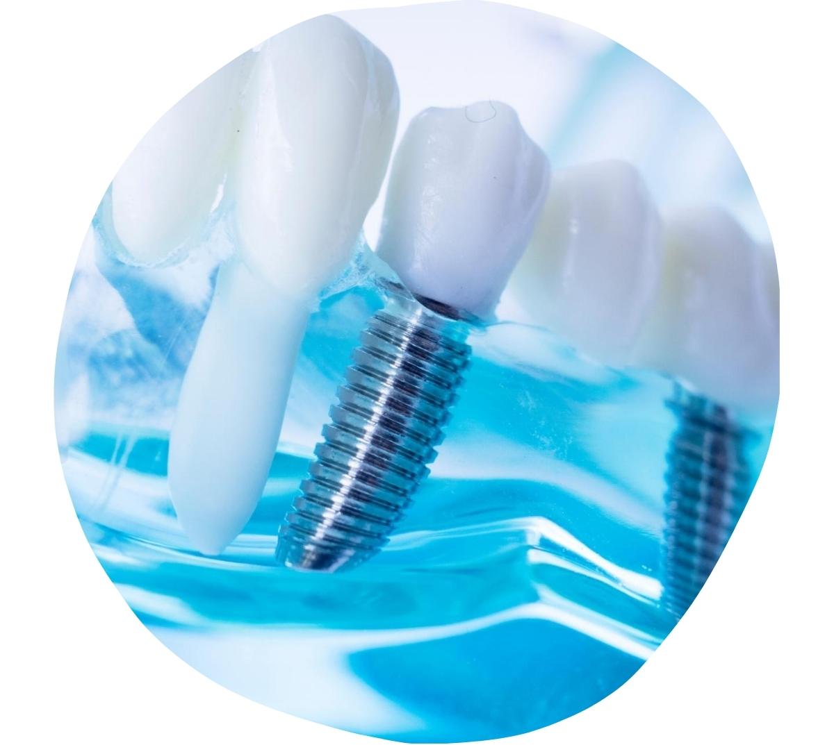 Dental implants in Mount Druitt NSW 2770