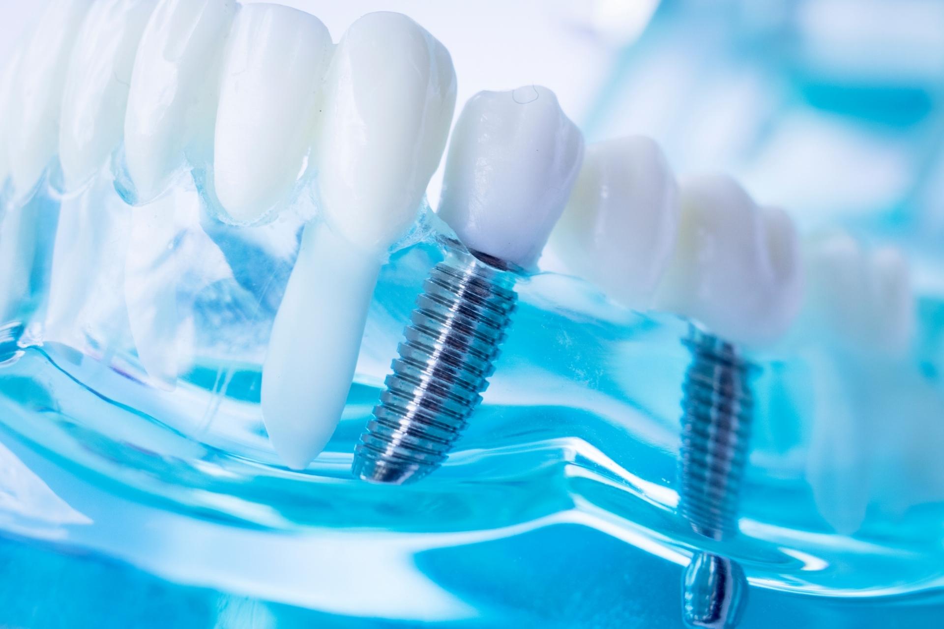 Affordable Dental Implants Mount Druitt Book Online Now!
