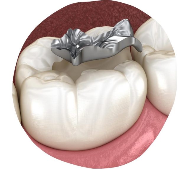 Dentures Mount Druitt • Partial & Complete Dentures